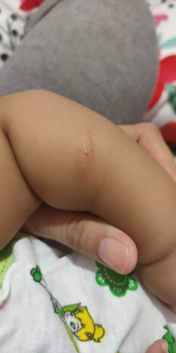 Ano kaya tong sa kamay ni bby. Kaninang umaga parang kagat lng ng langgam , tpos ngayon ganyan n sya