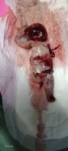 Ano po kya ung lumbas sa pwerta q po nba2hla po kc aq now lng po nangyri skn 2..