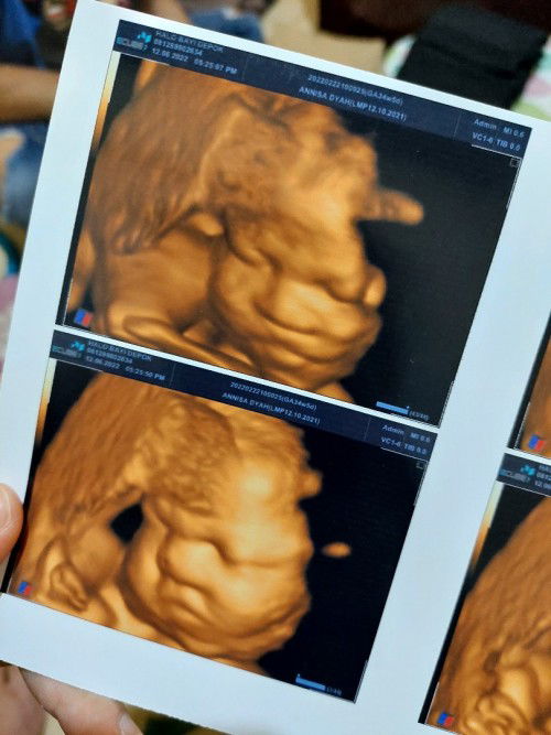 Usg bayi 34week berat 2.5kg