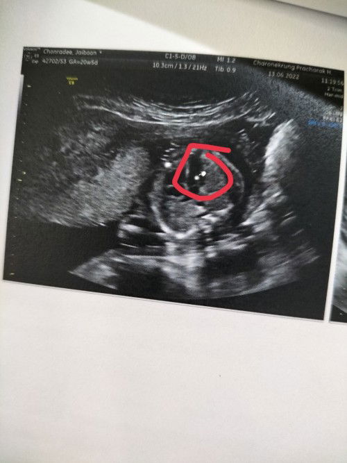 หินปูนในหัวใจลูก