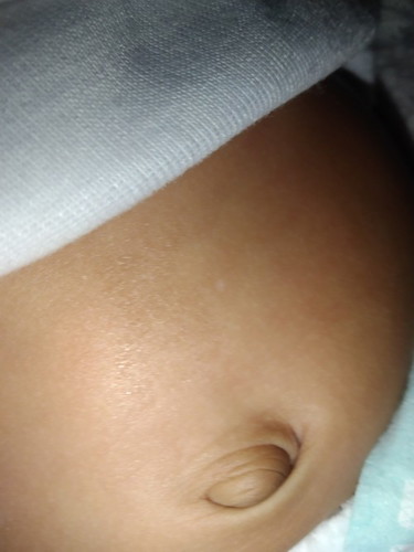 bun mau tanya apakah pusar kaya gini bentuk nya normal dan apakah akan masuk ke dalam umr bayi 3 bln