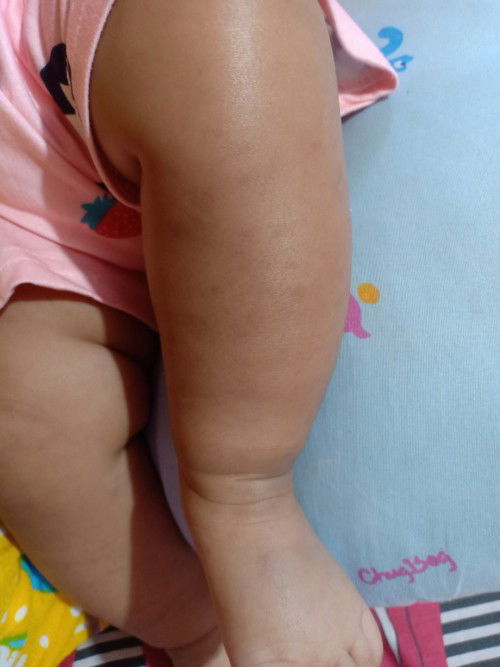 Bekas hitam2 di kulit