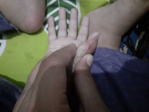 Bekas luka pada anak