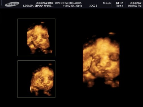 May baby boy at 30 weeks