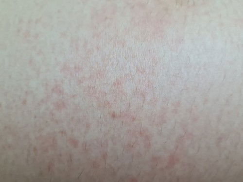 ทาเบบี้ออยล์แล้วแพ้มีผื่นขึ้นและคัน แม่ๆ คนไหนเป็นบ้างคะ ทาอะไรได้บ้างในเบื้องต้น