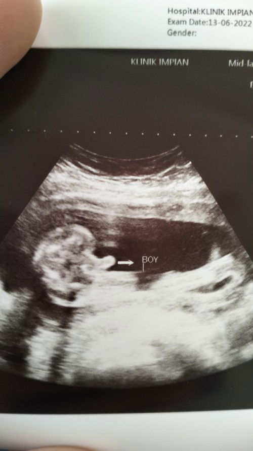 Scan gender baby 23w4d