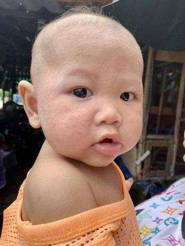 ผื่นอารัยคะ และจะรักษาแบบใหนดี