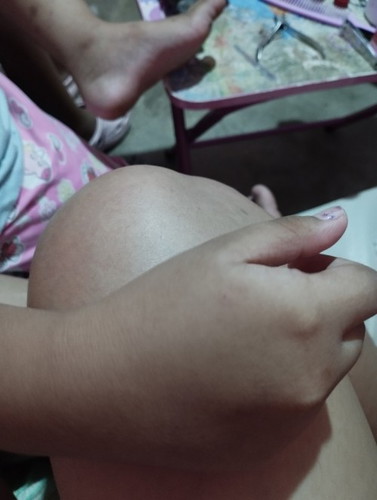 Nakagat ng aso o natusok lang ng ngipin? Namuo lang po ung dugo na maliit sa kamay pero walang dugo