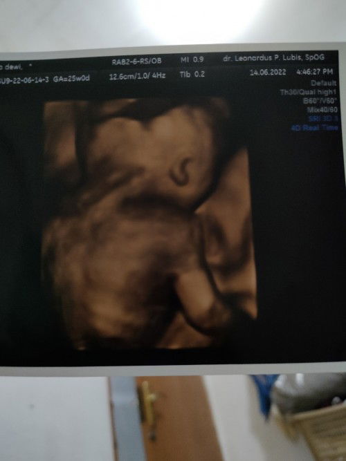 Kehamilan 25 week, baby sungsang?