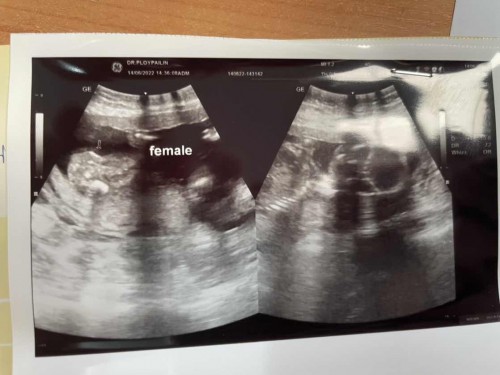 หมอบอกได้ลูกสาวค่ะ