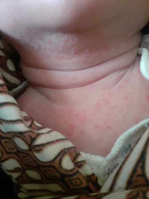 Bayi 12 hari muncul bintik merah
