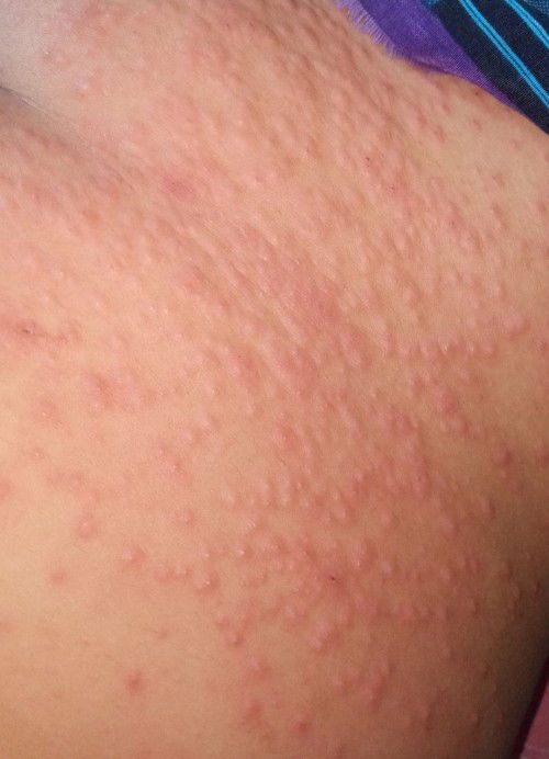 Ruam di perut gatal dan perih semakin menyebar