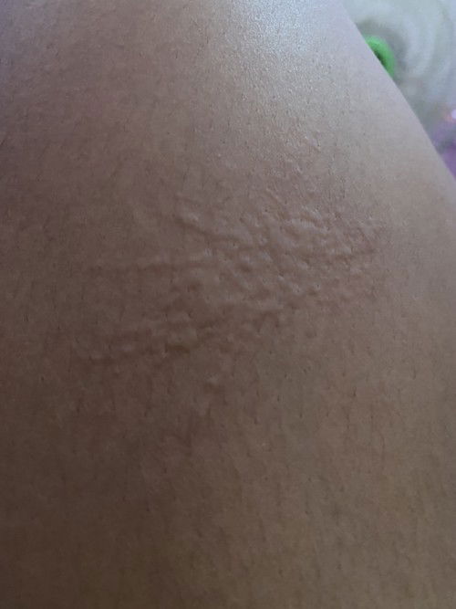 ผื่นคันทำไงดีค่ะ อันตรายไหม