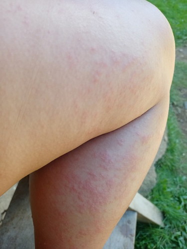 Rashes or Allergy?
Sino po dito nakaranas ng ganitong klase ng rashes o allergy?