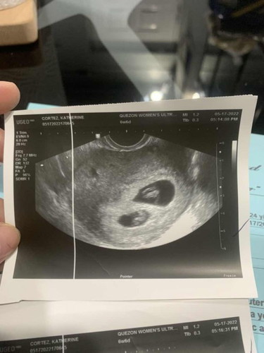 Twin Pregnancy Experience