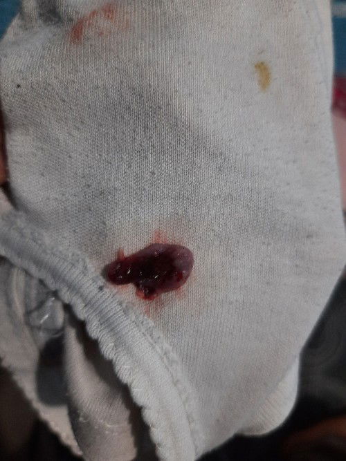 KEGUGURAN USIA KANDUNGAN 6 MINGGU