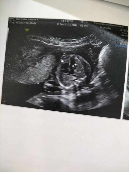 พบหินปูนในหัวใจทารก