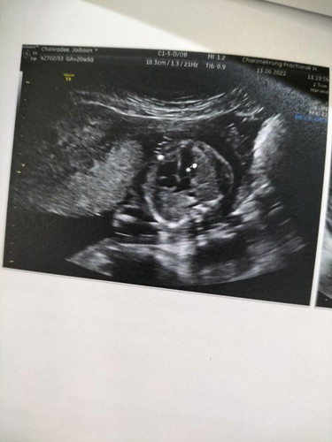 พบหินปูนในหัวใจทารก