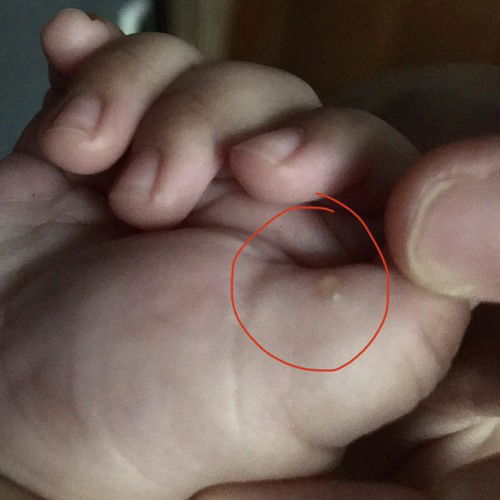 Bintik Berair Pada Bayi