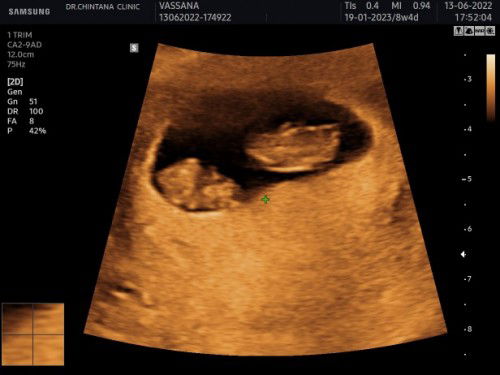 ลูกแฝด ถุงใบเดียวกัน