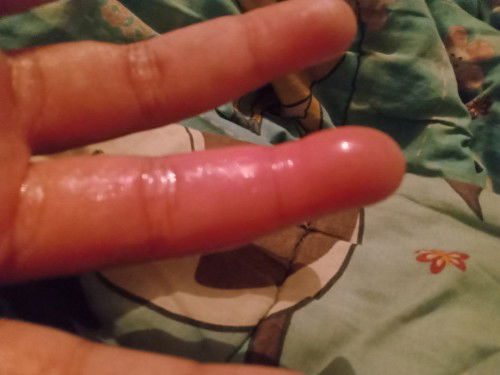 สอบถามแม่ๆในกลุ่มหน่อยค่ะ ตอนนี้ท้องได้14สัปดาห์เมื่อคืนโดนแมงป่องต้อย