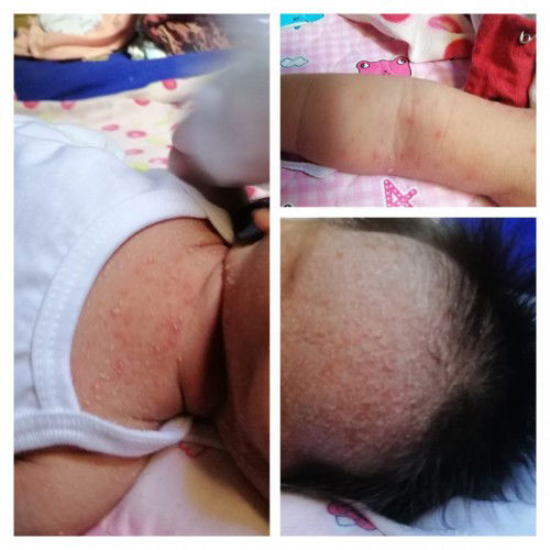 Sinu po may same case kagaya ng baby ko?