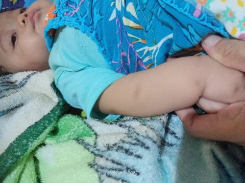 Bekas hitam gigitan nyamuk