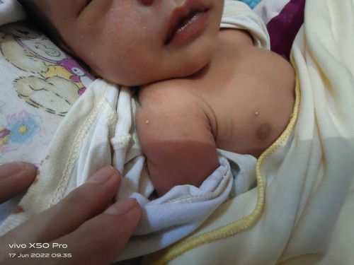 Bintik bintik ada nanah di kepala dan badan