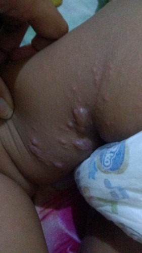 mom kalo cacar air yang bagus pakai apa ya suapaya cepat kering