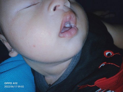 Obat sariawan bayi 2bln krna air susu