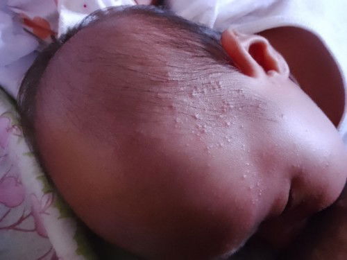 Butlig/Rashes sa mukha hanggang leeg ni baby 1 month old.