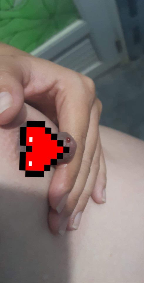 ตั้งครรภ์28สัปดาห์ มีเลือดออกที่หัวนม