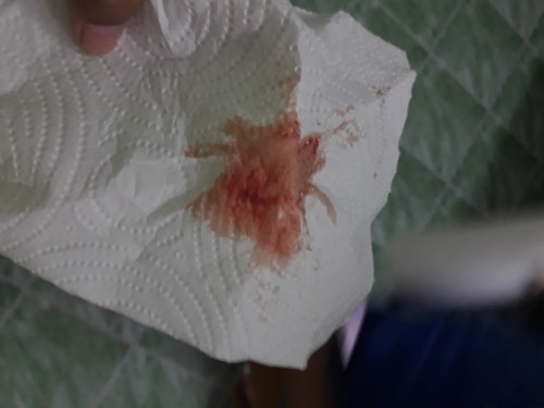 เลือดออกขณะตั้งครรภ์