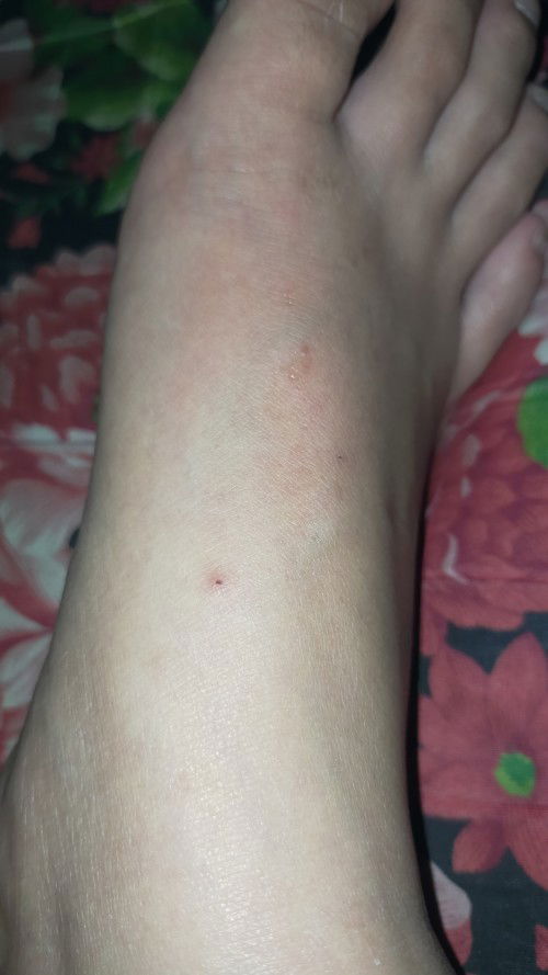 ano po kayang dahilan ng pangangati ngaun pong 31 weeks bigla ako nangati paa hanggang likod po