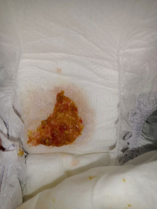 Dugo sa dumi ni baby