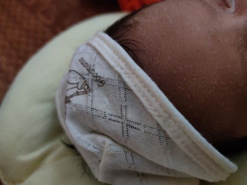 Con bị rôm sảy vàng da