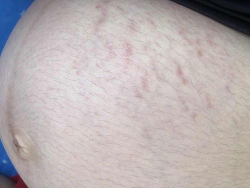 36วีคแล้วท้องมาแตก