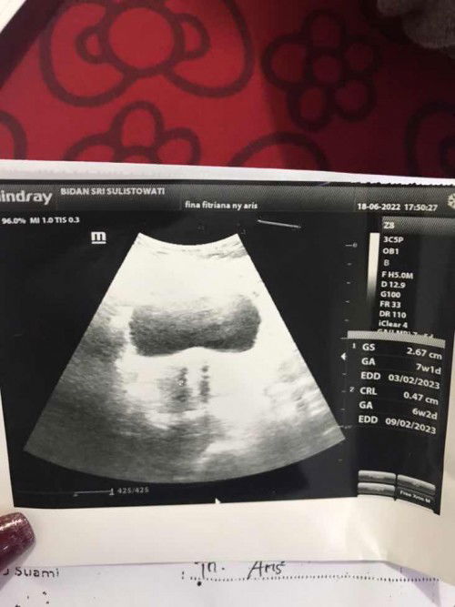 Usg usia 7 week 5 day, masih bingung