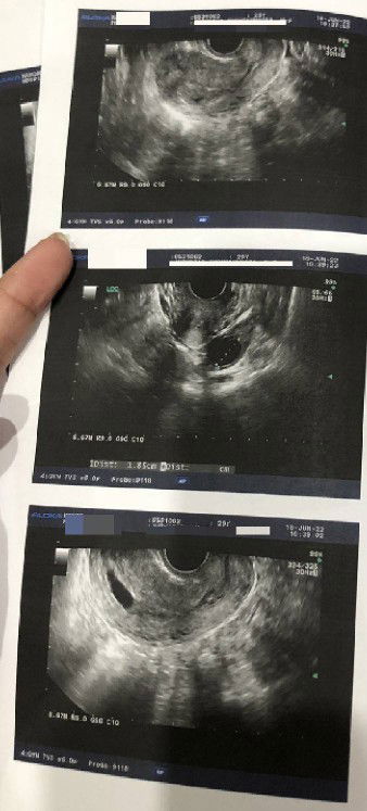 กลุ้มใจ 8week ซาวด์ไม่เจอตัวเด็กเลยค่ะ