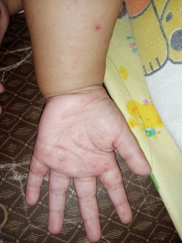 Malam,Bun ada yg tau gak sih ini alergi apa ? Soalnya anak saya suka garuk-garuk (gatal)