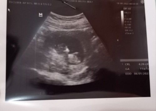 Hasil usg pertama kehamilan pertama,penantian 1 tahun