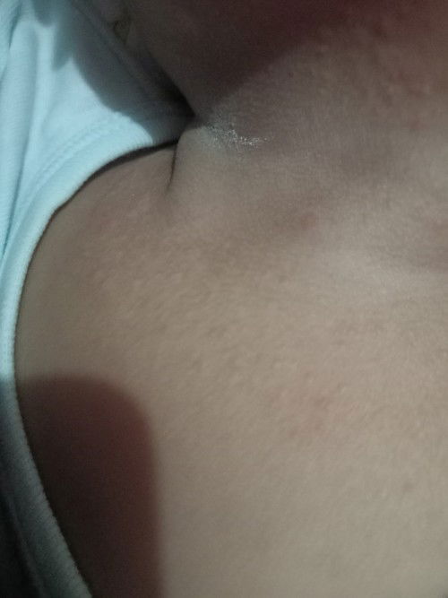 Hello mga mommies pa help po anu po gamot sa rashes ni baby sa leeg at mukha