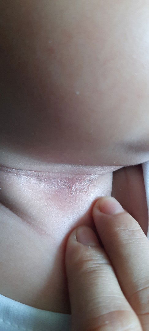 Bé nổi này là gì ạ ? Trị thế nào ? Giúp với các m ơi🤔🤔🤔