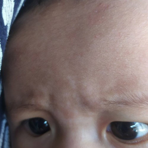 Bercak putih pada kening bayi