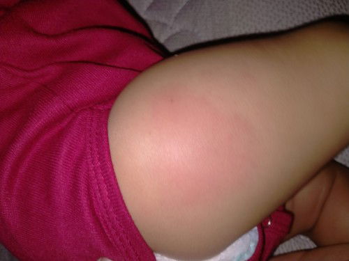 Bengkak setelah imunisasi