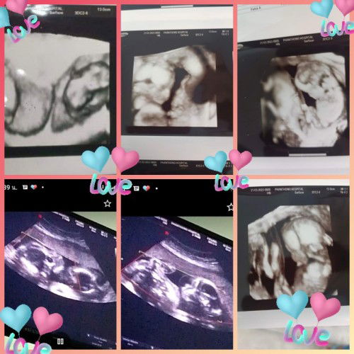 ท้องแฝด29สัปดาห์แล้ว