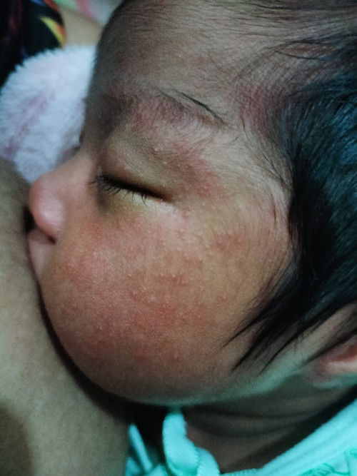 หน้าน้องเป็นตุ่มๆ