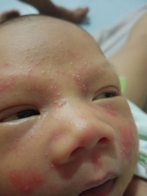 น้องมีผื่นขึ้น เต็มหน้าเลยค่ะ