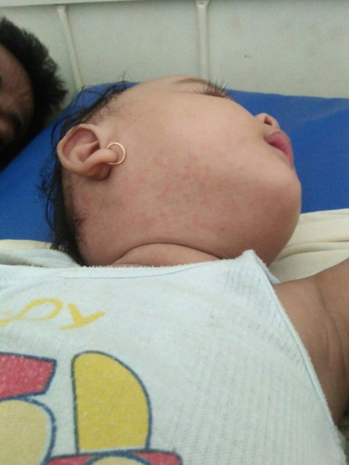 Obat ruam pd kulit bayi