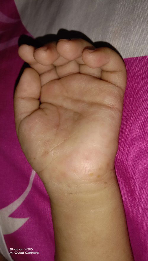 Gatal pada anak tak sembuh sembuh